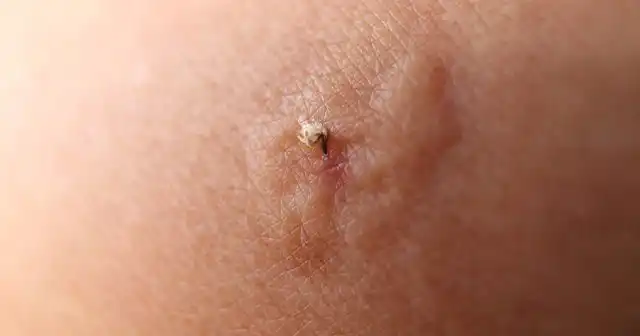 В ранку попадает яд, состоящий из сложного набора различных органических соединений, которые вызывают сильнейшую боль, отёчность и зуд