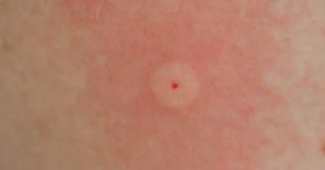 След от укуса осы