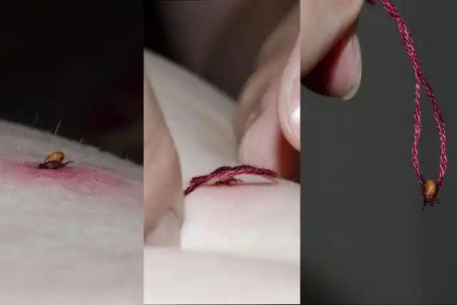 Удаление клеща ниткой