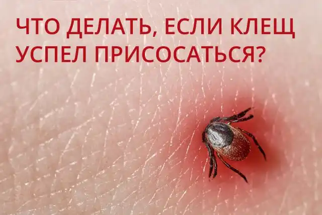 Что делать, если клещ успел присосаться?