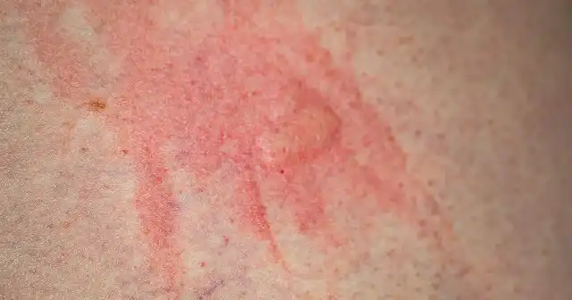 Укусы клопов могут быть одиночными или в виде хаотичных групп