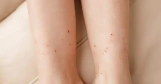 Но только и для людей блохи приготовили ряд «сюрпризов», от которых не избавиться простой таблеткой и мазью.