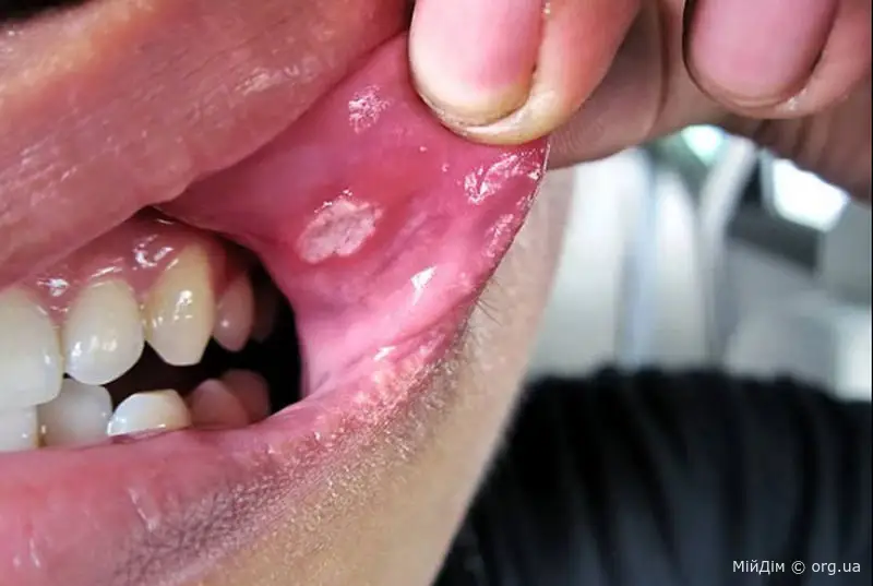 Стоматит у дітей: що це таке та