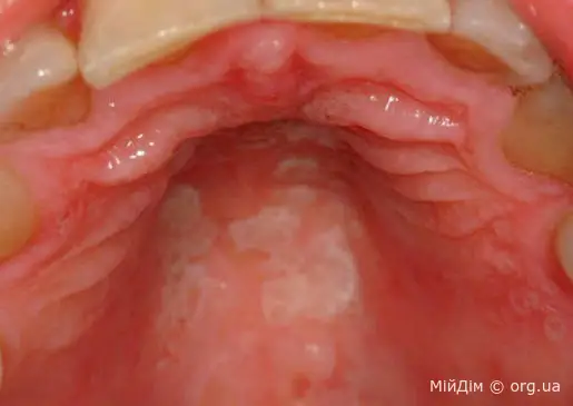 Стоматит в Дитини