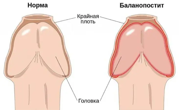 баланопостит - це запалення крайньої плоті і головки статевого члена