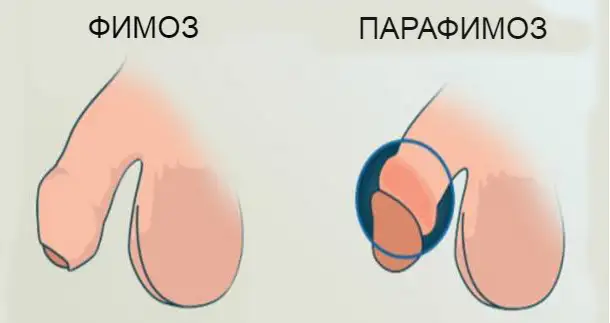 Патологічний фімоз