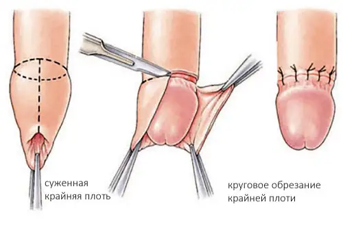 Лікування фімозу у хлопчиків