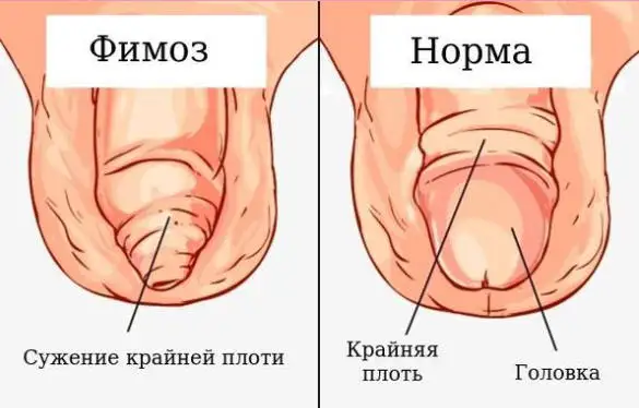 Фімоз і Норма у дитини