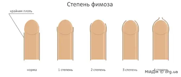 Фімоз: що мають знати батьки хлопчика?