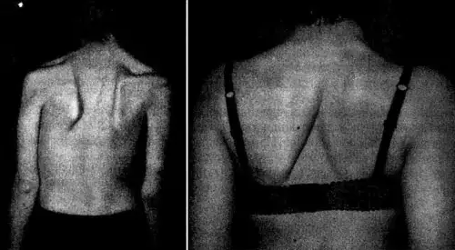 Наслідки поліомеліта на спині жінки